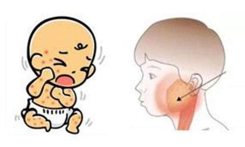 腮腺炎小儿推拿手法