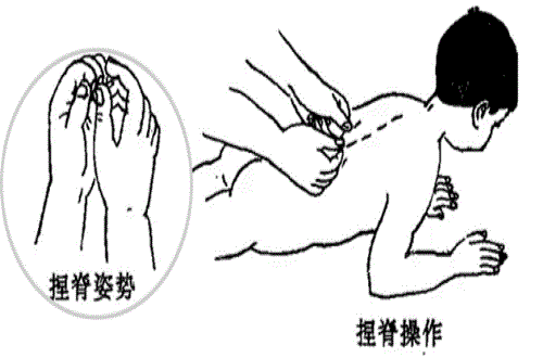 小儿推拿捏脊