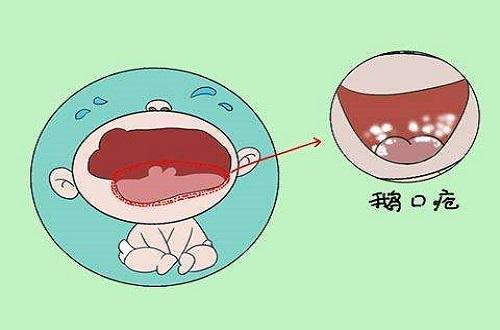 鹅口疮推拿手法