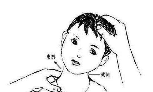 小儿肌性斜颈按摩手法