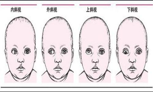 小儿斜视推拿图片